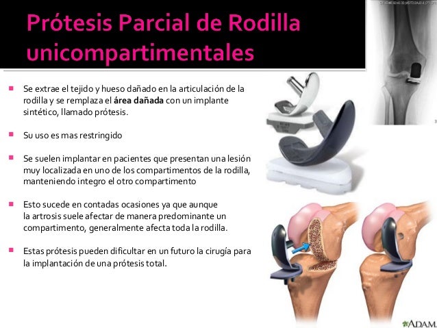 Artroplastia Parcial De Rodilla Pdf